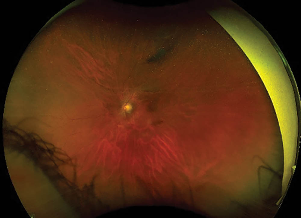 PickleballRelated Eye Injuries New Retinal Physician